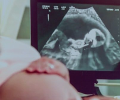 Imagem de ultrassom do bebê na tela, representando o ultrassom 3D/4D